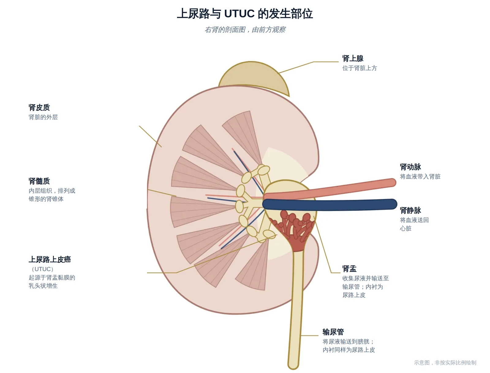 右肾剖面示意图，显示肾盂、输尿管，以及上尿路上皮癌的发生部位。