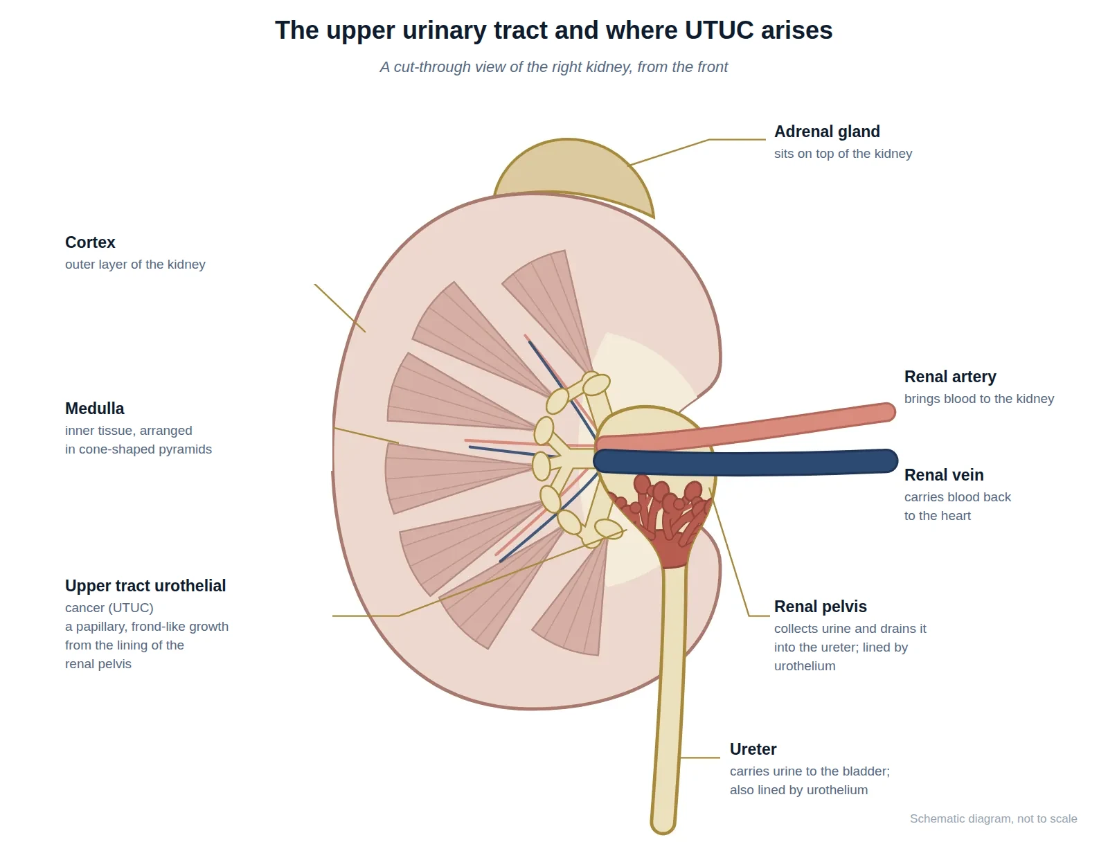 Cut-through diagram of the right kidney showing a papillary upper tract urothelial cancer growing from the lining of the renal pelvis, with the renal pelvis draining into the ureter, the renal artery and vein, cortex, medulla and adrenal gland.