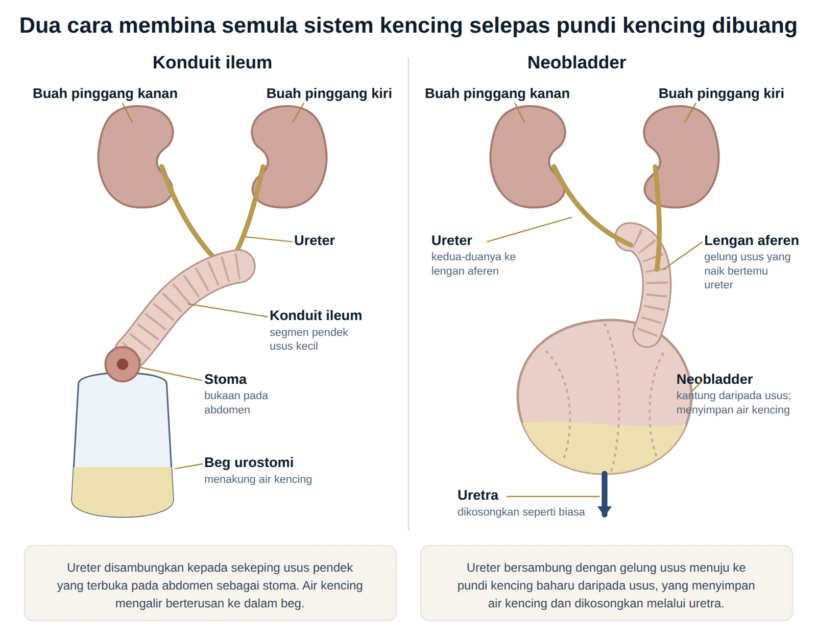 Rajah dua cara membina semula sistem kencing selepas pundi kencing dibuang — konduit ileum dengan stoma, dan neobladder.