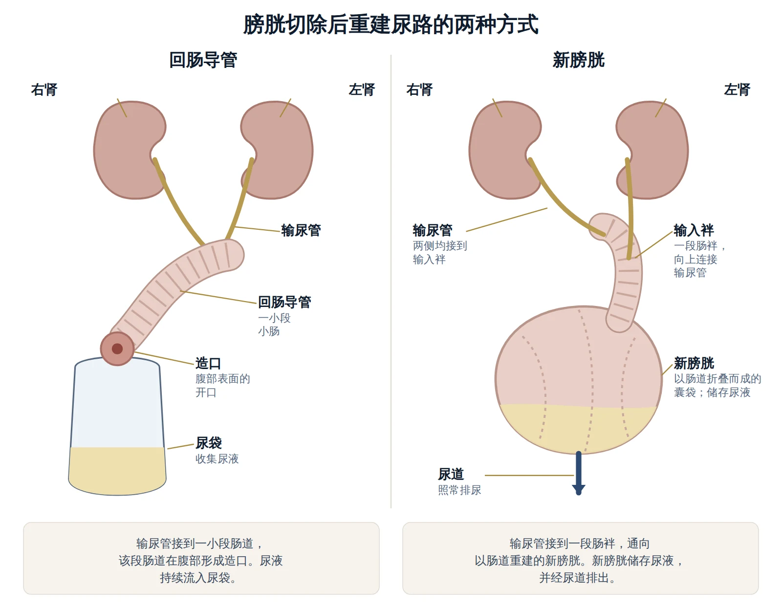 膀胱切除后重建尿路的两种方式示意图：带造口的回肠导管，以及以肠道重建的新膀胱。