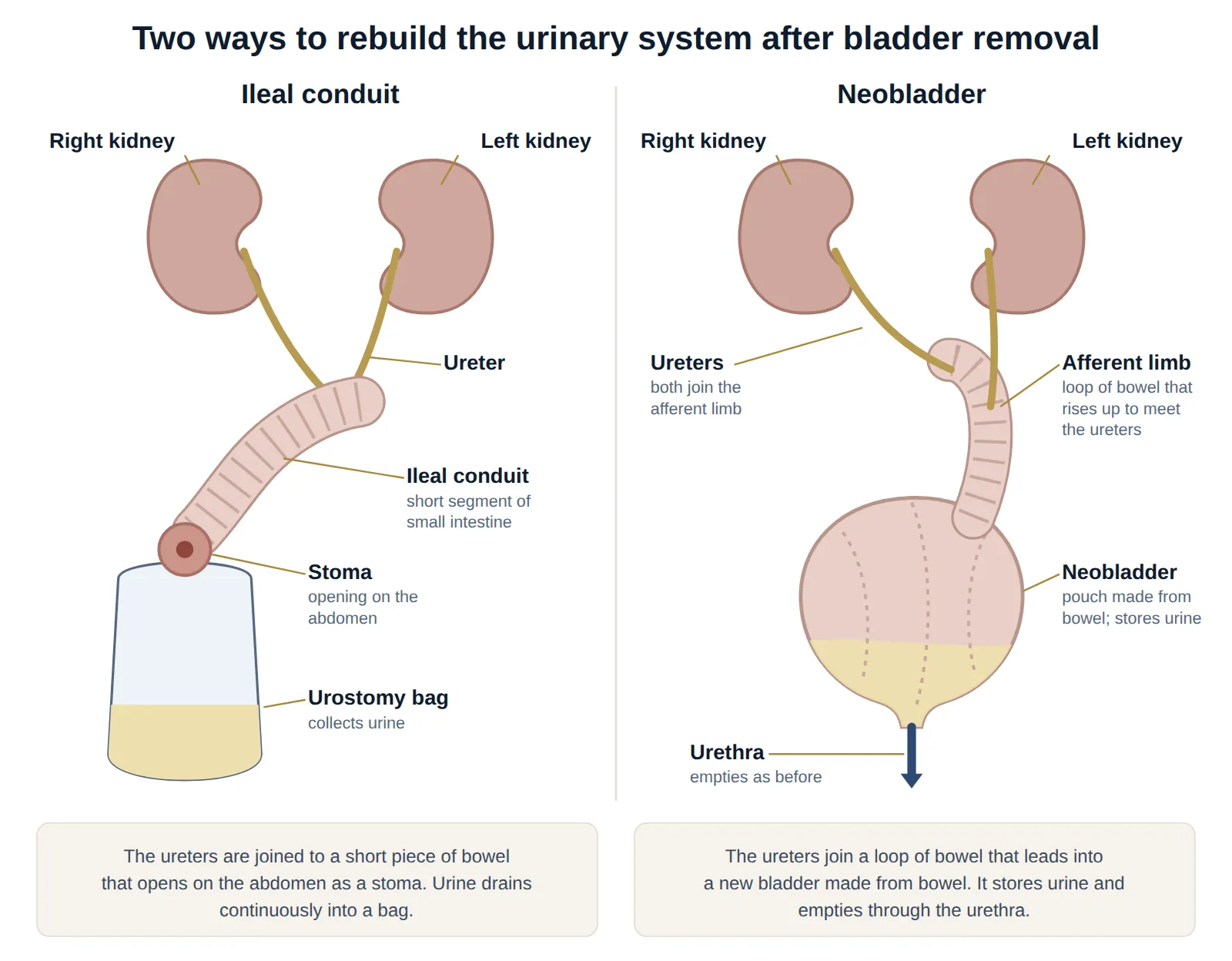 Two diagrams: an ileal conduit, where the ureters join a short segment of bowel that opens as a stoma into a urostomy bag; and a neobladder, where both ureters join a rising loop of bowel leading into a pouch made from bowel that empties through the urethra.