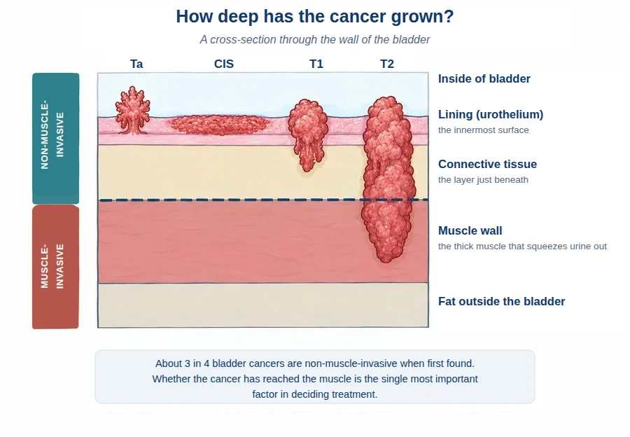 Cross-section through the bladder wall showing how deep bladder cancer has grown — Ta, CIS and T1 are non-muscle-invasive; T2 and beyond are muscle-invasive.