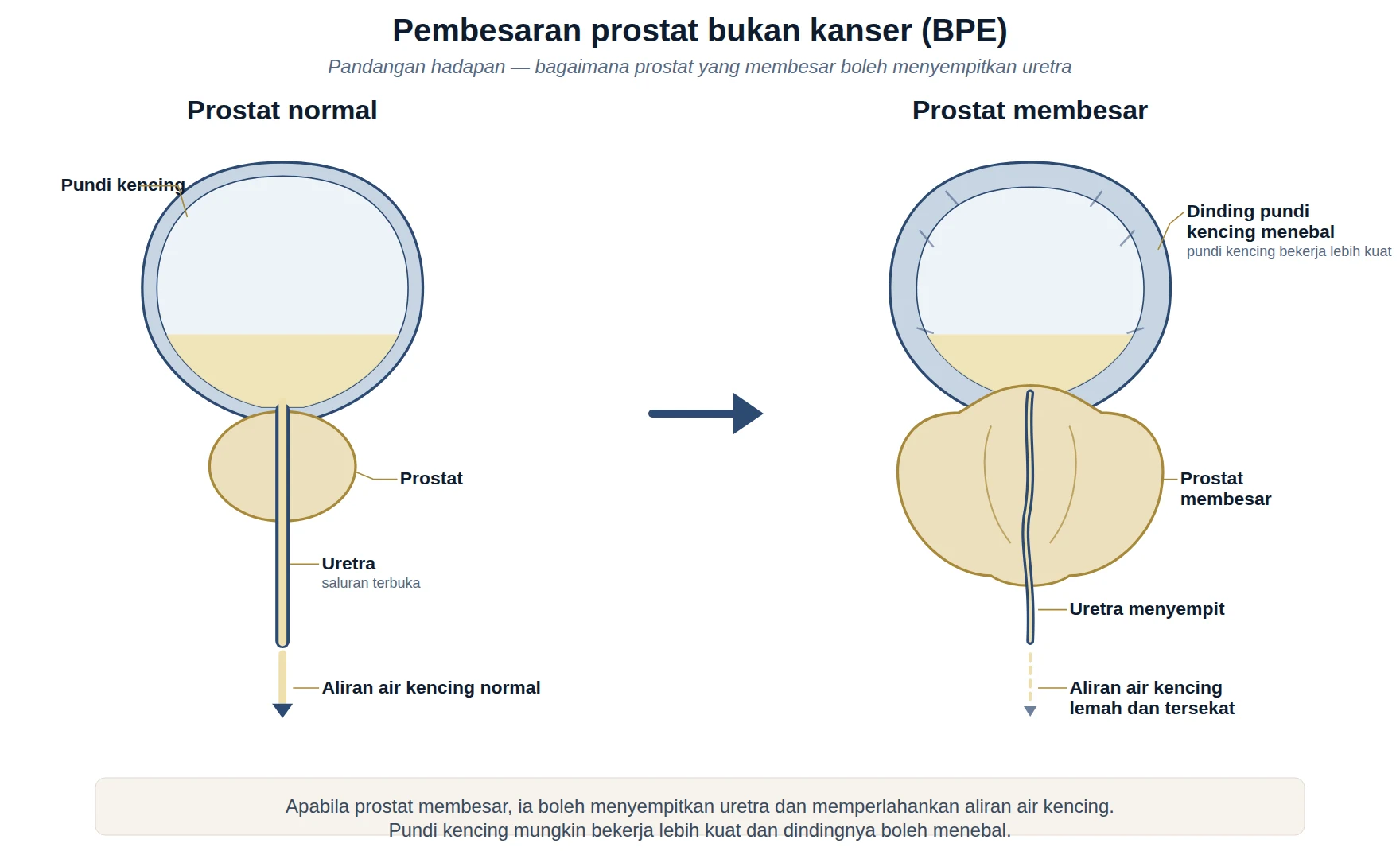 Rajah pandangan hadapan membandingkan prostat normal dengan prostat yang membesar menyempitkan uretra.
