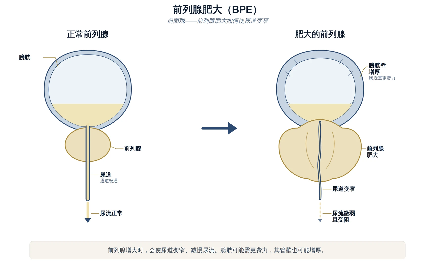 正常前列腺与肥大前列腺的前面观示意图，显示前列腺肥大如何使尿道变窄。