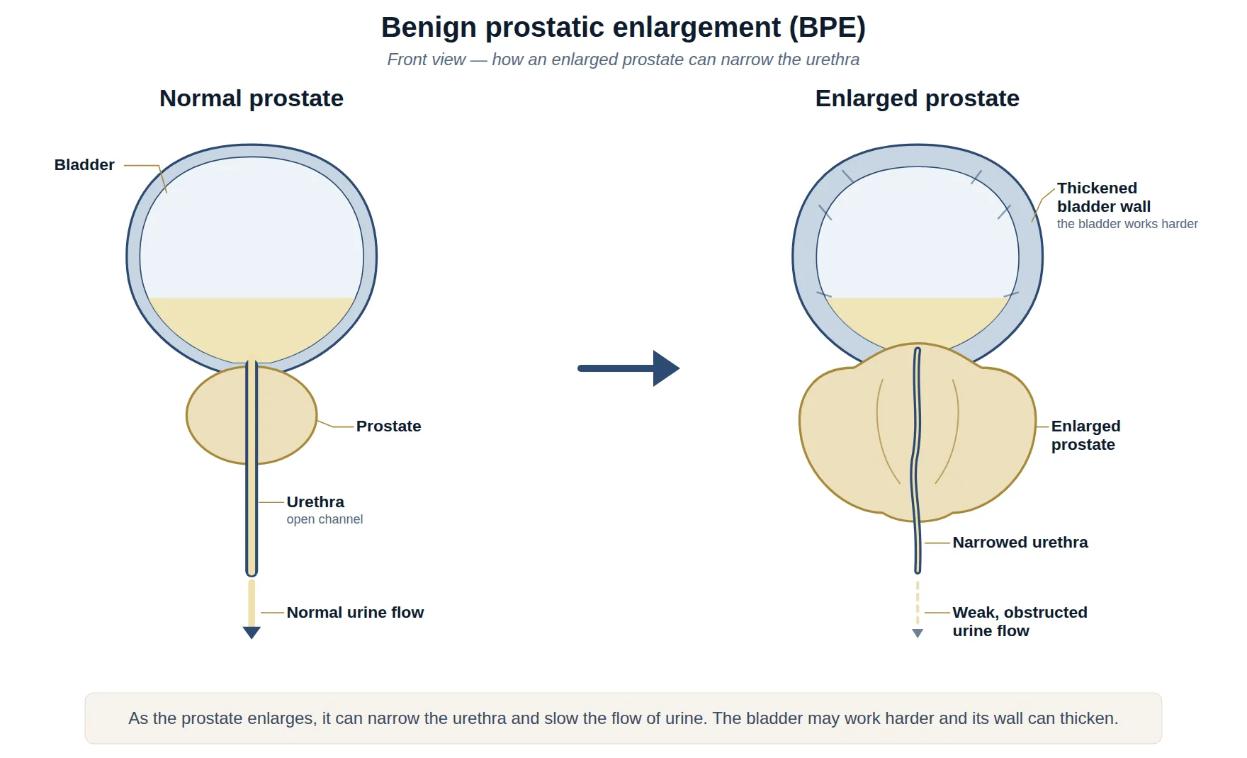 Front-view diagrams comparing a normal prostate with an open urethra and strong urine flow, and an enlarged prostate that narrows the urethra, weakens urine flow and thickens the bladder wall.