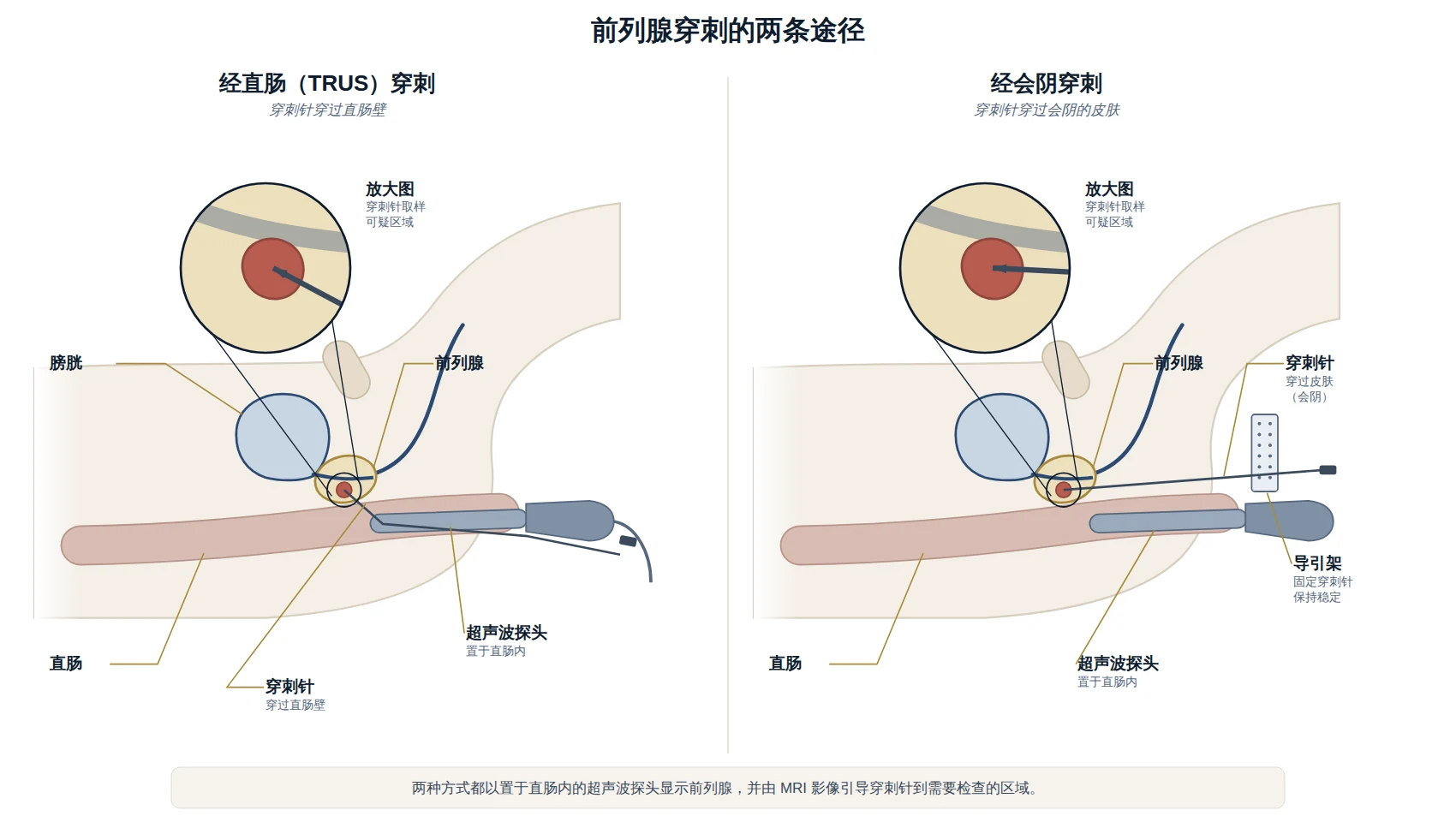 前列腺穿刺两条途径的示意图：经直肠穿过直肠壁，以及经会阴穿过会阴皮肤。