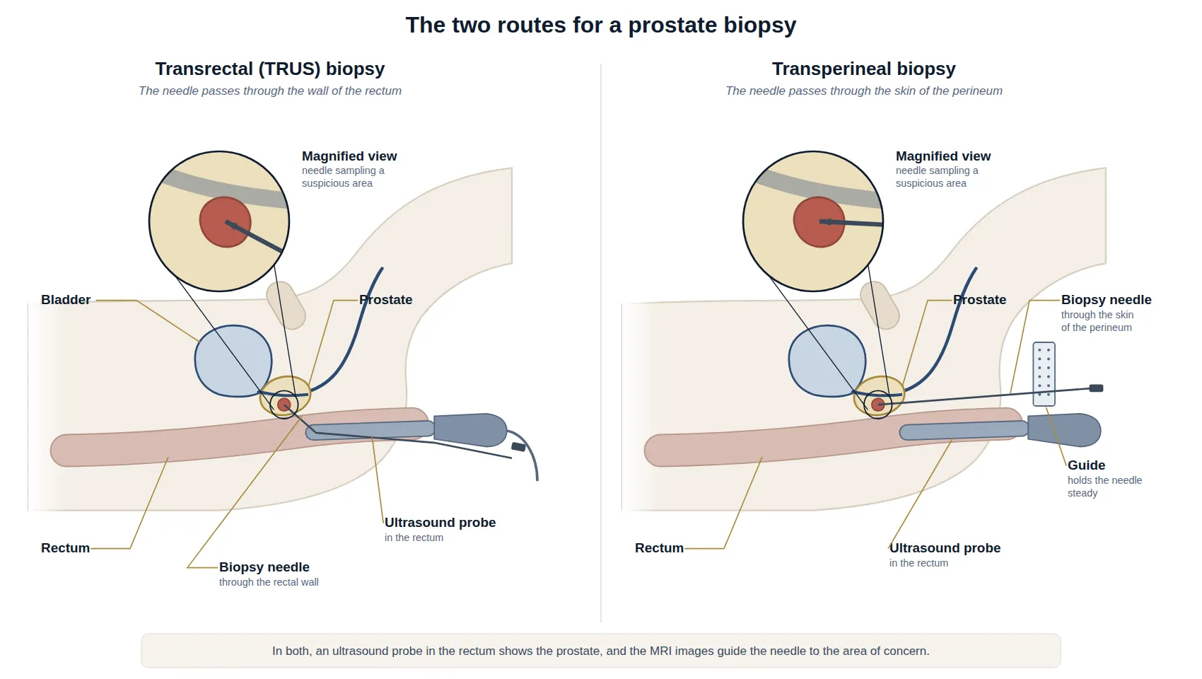 Two side-view diagrams of prostate biopsy: on the left, a transrectal biopsy with the needle passing through the wall of the rectum beside the ultrasound probe; on the right, a transperineal biopsy with the needle passing through a guide and the skin of the perineum.