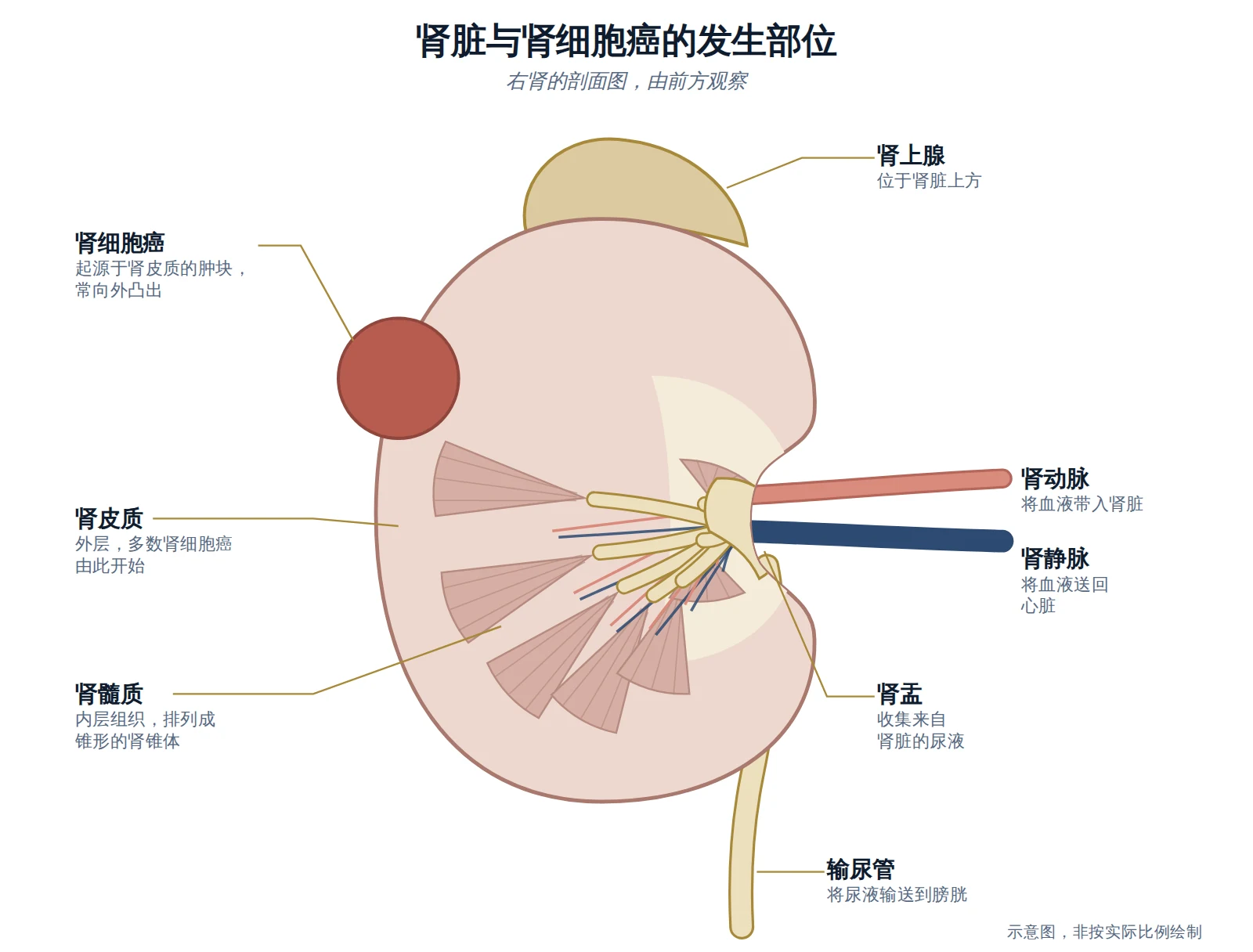 Cut-through diagram of the right kidney showing a mass bulging from the cortex, with the medulla, renal pelvis draining into the ureter, renal artery and vein, and adrenal gland.