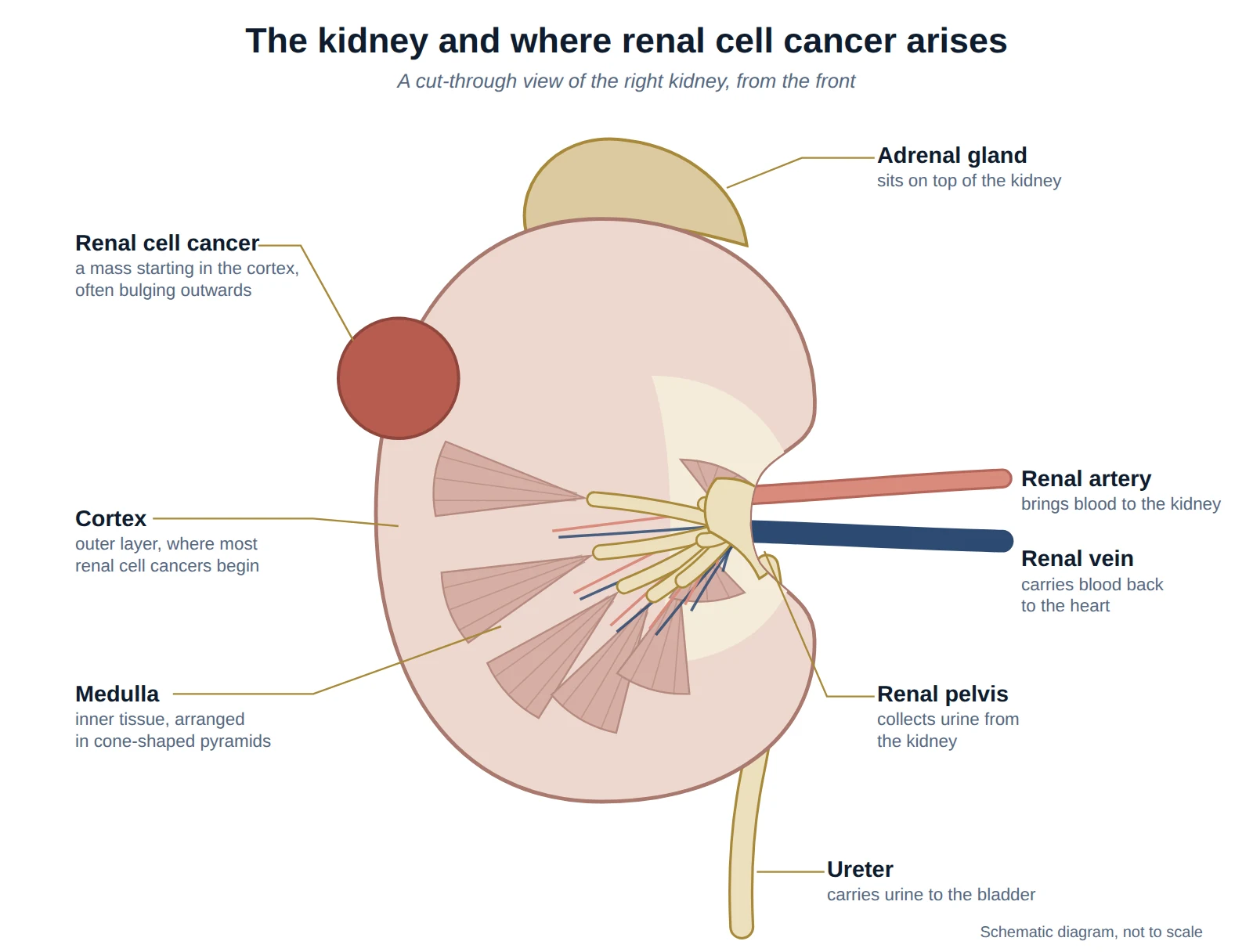 Cut-through diagram of the right kidney showing a mass bulging from the cortex, with the medulla, renal pelvis draining into the ureter, renal artery and vein, and adrenal gland.