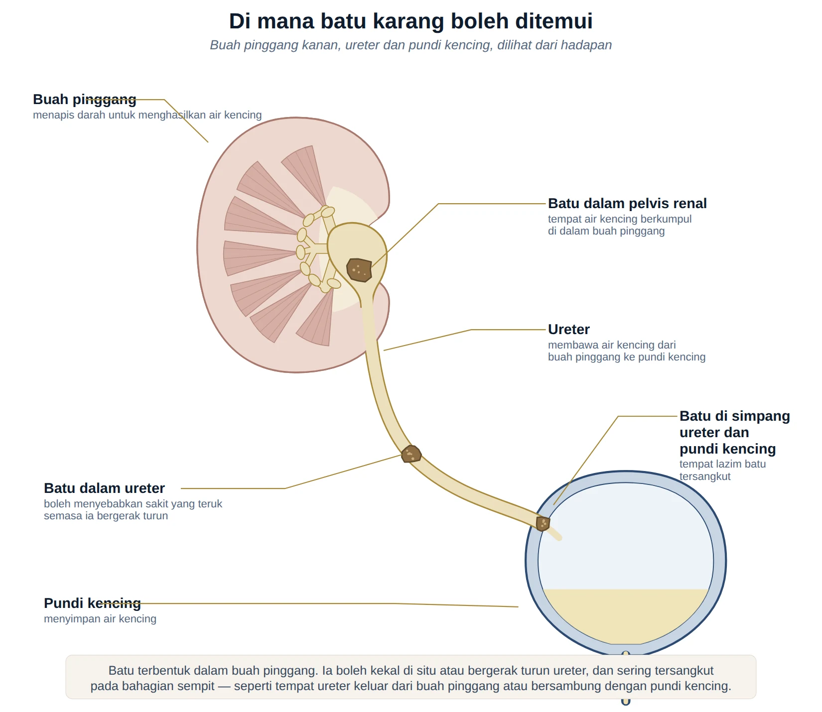 Rajah buah pinggang kanan, ureter dan pundi kencing menunjukkan tempat batu karang boleh berada.