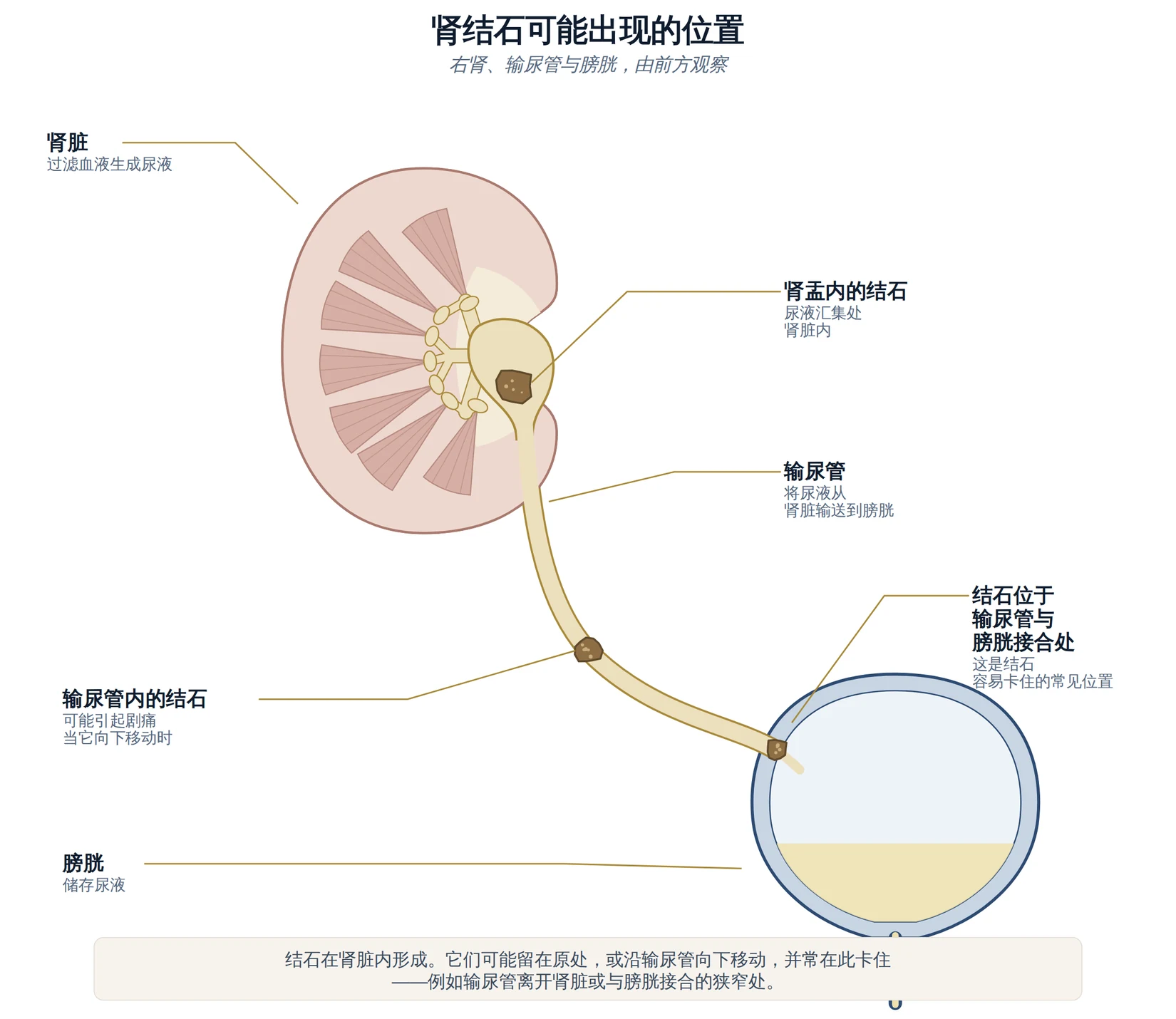 右肾、输尿管与膀胱的示意图，显示肾结石可能出现的位置。