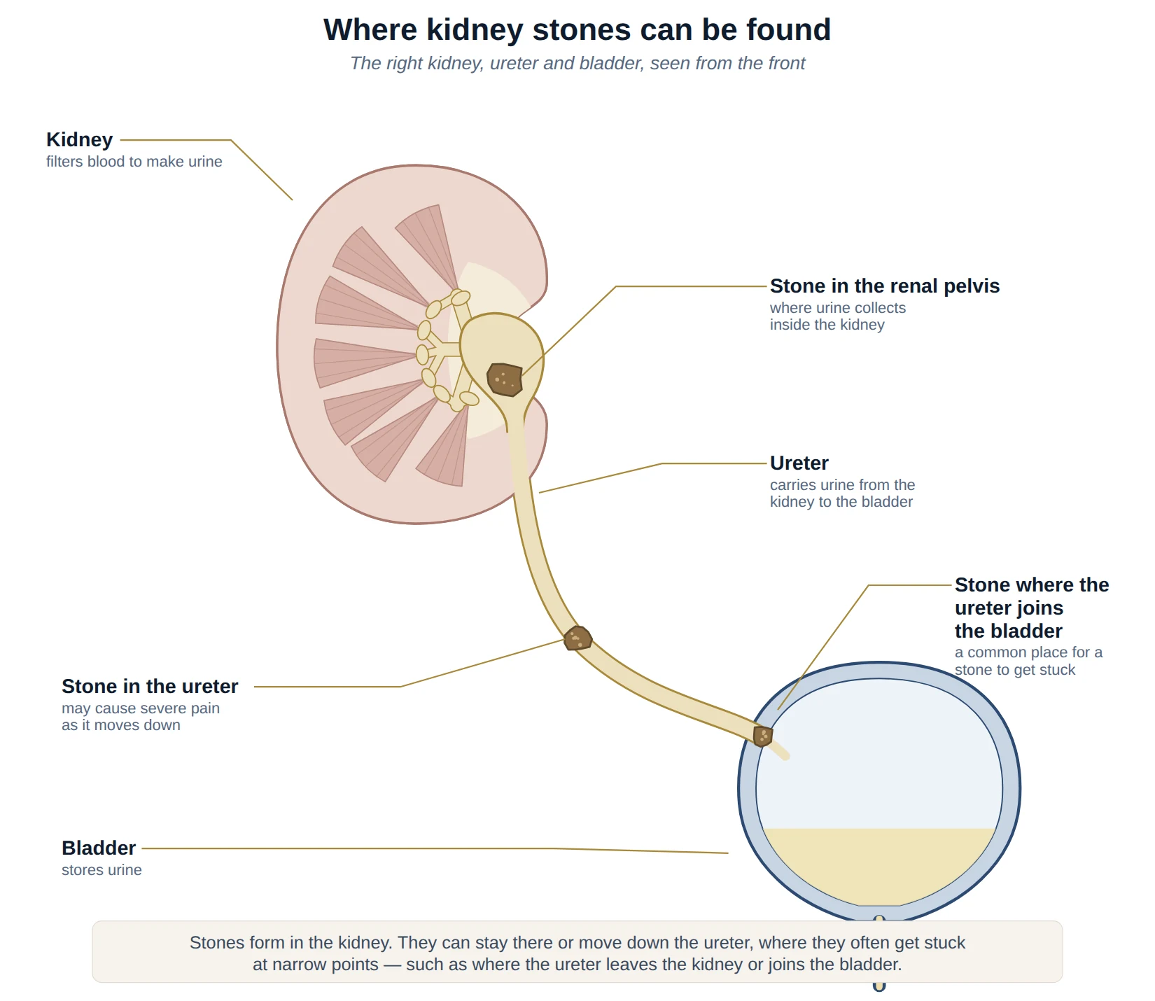 Diagram of the right kidney, ureter and bladder showing kidney stones in the renal pelvis, part-way down the ureter, and where the ureter passes through the bladder wall to open near its base.