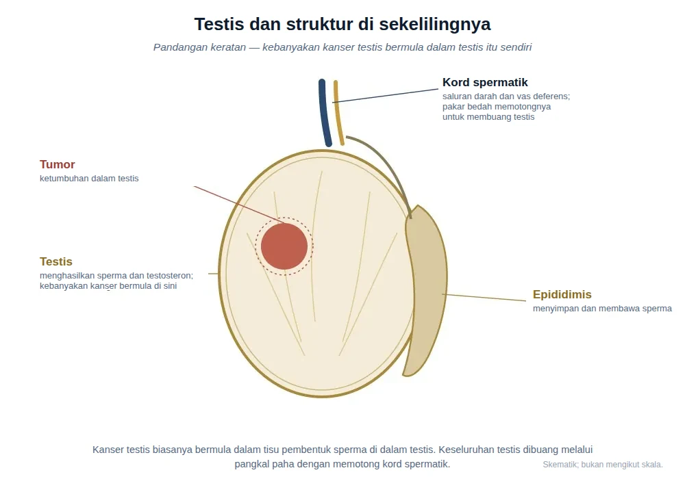 Rajah keratan testis menunjukkan tumor dalam testis, epididimis dan kord spermatik.