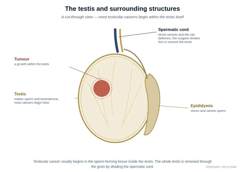 Cut-through diagram of the testis showing the testis, epididymis, and spermatic cord, with a tumour arising within the testis.
