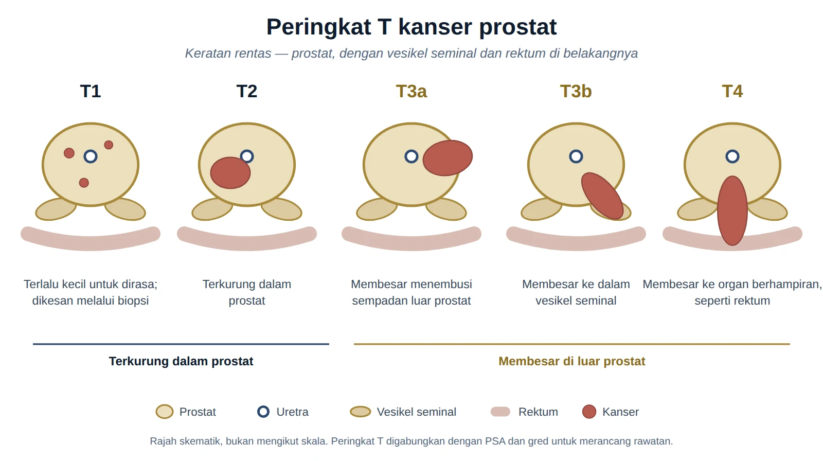 Rajah peringkat T kanser prostat, daripada tumor kecil dalam prostat hingga kanser yang membesar ke organ berhampiran.