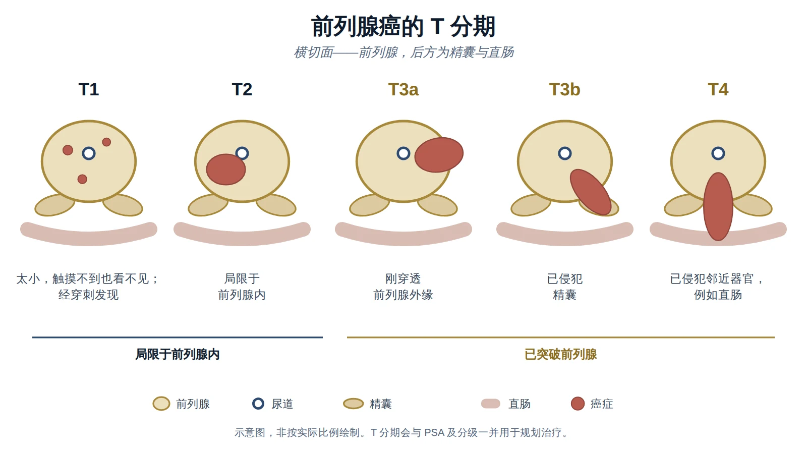 前列腺癌 T 分期示意图，从局限于前列腺内的小肿瘤到已侵犯邻近器官的癌症。