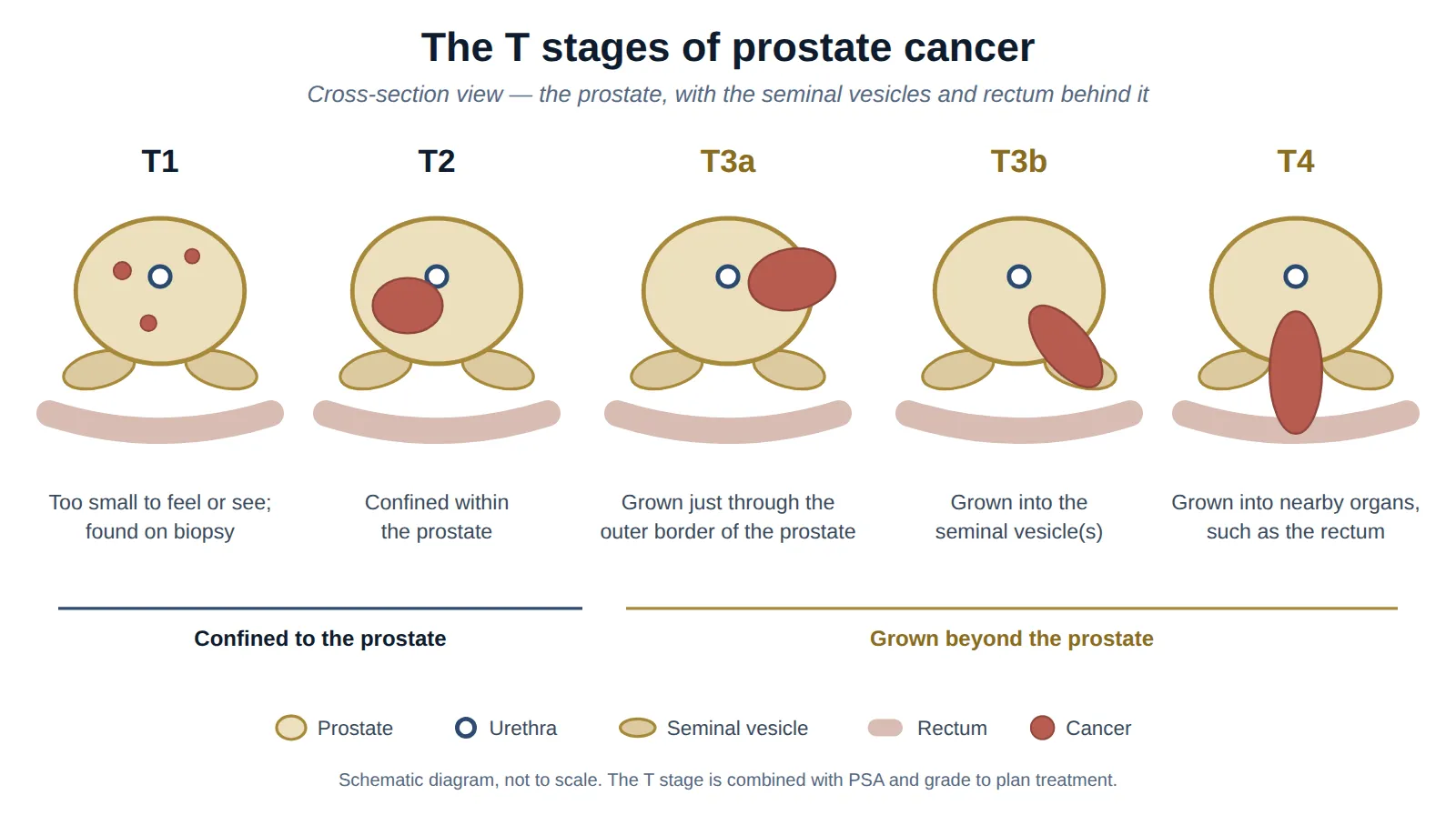 Cross-section diagrams of the T stages of prostate cancer: T1 tiny tumours inside the prostate; T2 a tumour confined within the prostate; T3a a tumour growing just through the outer border; T3b a tumour growing into a seminal vesicle; T4 a tumour growing into the rectum.