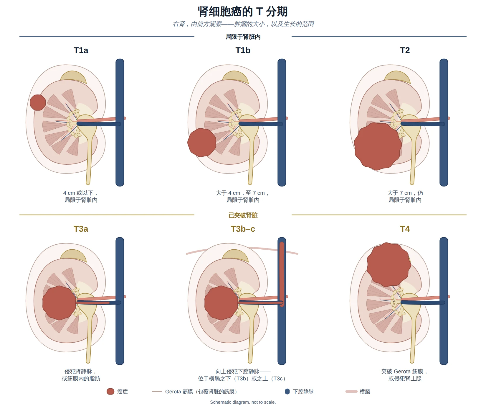 肾细胞癌 T 分期示意图，从局限于肾脏的小肿瘤到突破 Gerota 筋膜的癌症。