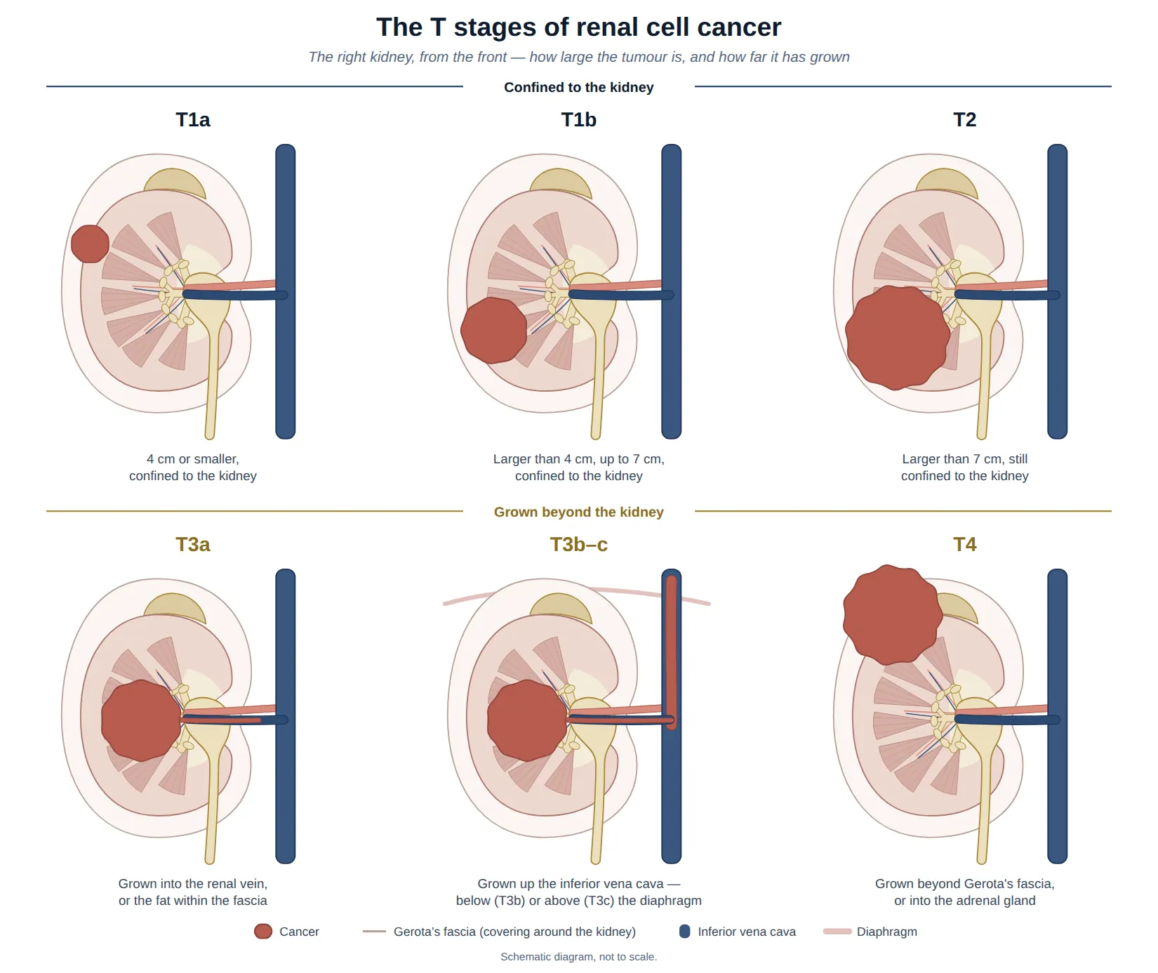 Six diagrams of the right kidney showing the T stages of renal cell cancer: T1a a tumour 4 cm or smaller; T1b 4 to 7 cm; T2 larger than 7 cm, all confined to the kidney; T3a grown into the renal vein; T3b–c grown up the inferior vena cava below or above the diaphragm; T4 grown beyond Gerota’s fascia into the adrenal gland.