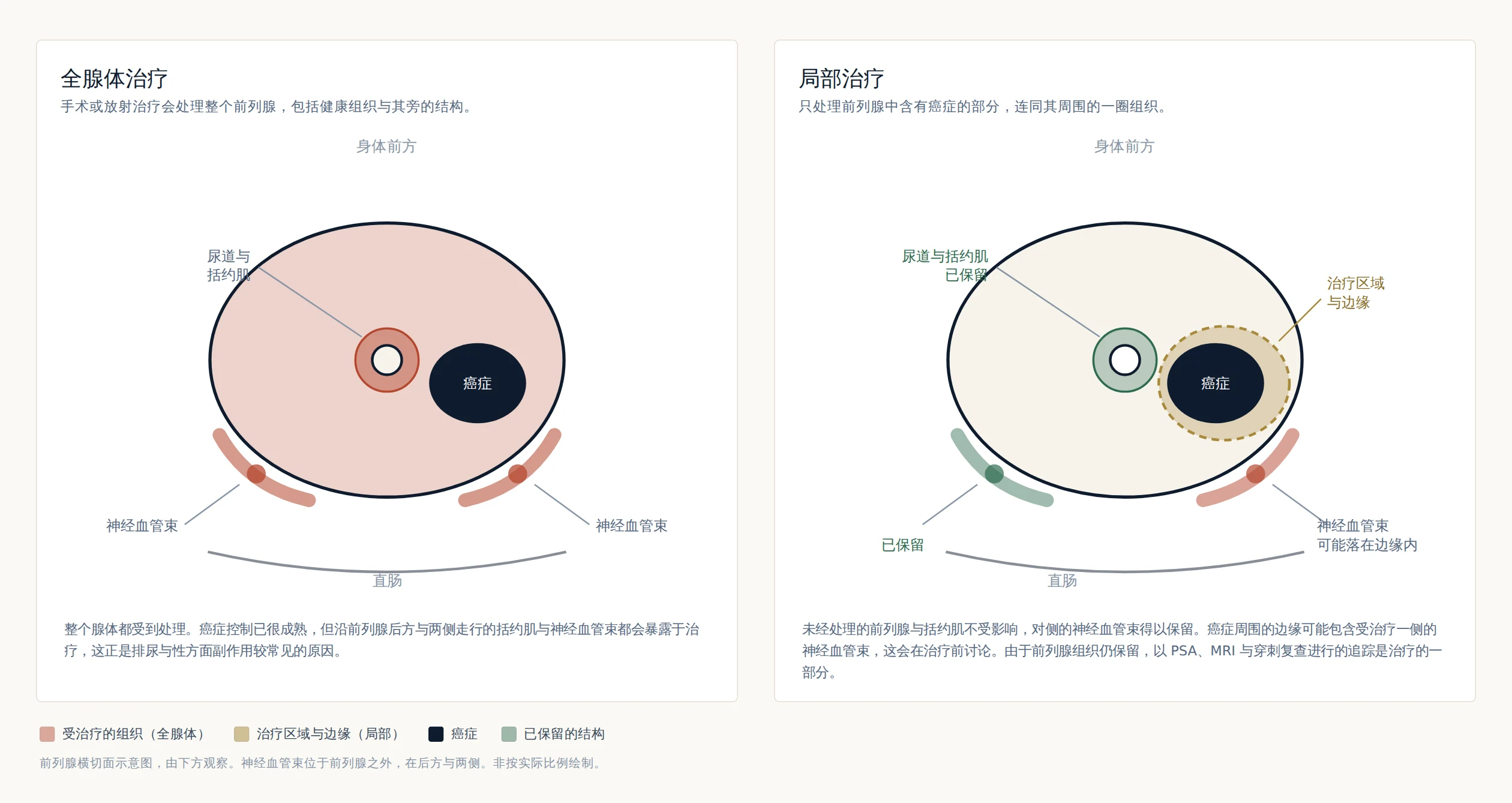 两幅示意图，比较全腺体治疗（整个前列腺、括约肌与两侧神经血管束都受处理）与局部治疗（只处理癌症及其周围的边缘）。