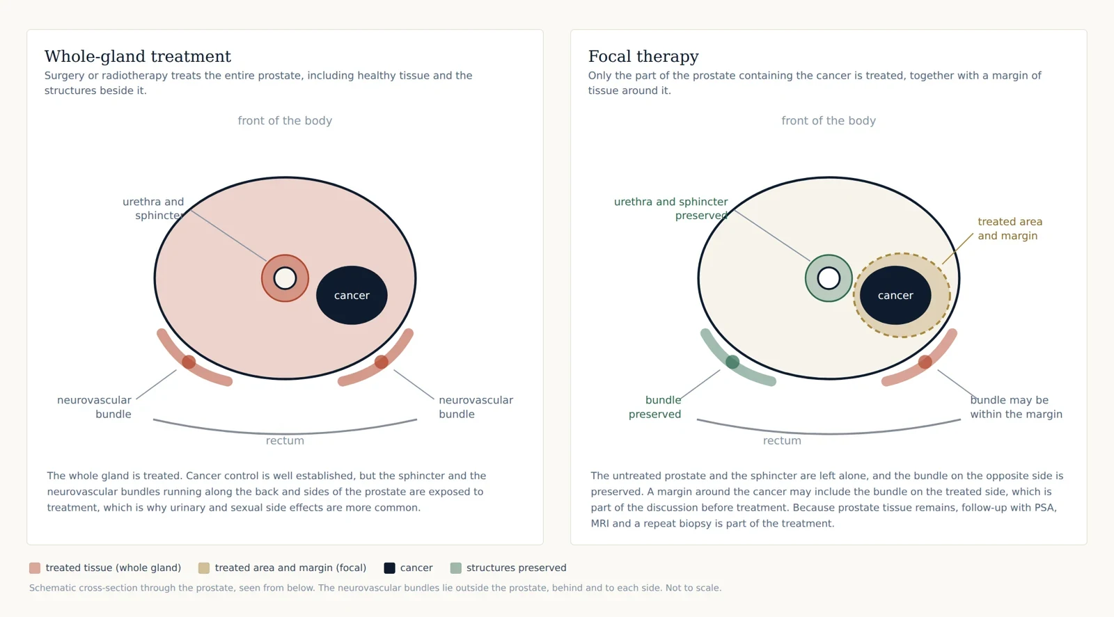Two diagrams comparing whole-gland treatment, where the entire prostate, the sphincter and both neurovascular bundles are treated, with focal therapy, where only the cancer and a margin around it are treated.